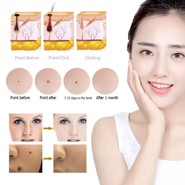 PEN REMOVEDOR DE LUNARES, PECAS, VERRUGAS, ACROCORDONES™