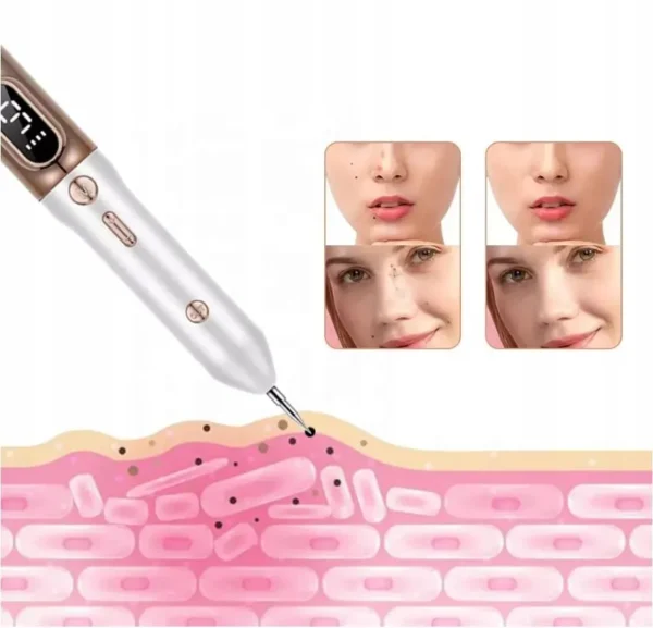 PEN REMOVEDOR DE LUNARES, PECAS, VERRUGAS, ACROCORDONES™