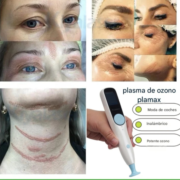 PLASMA PEN CON OZONO 2 EN 1 PLAMAX(TM)