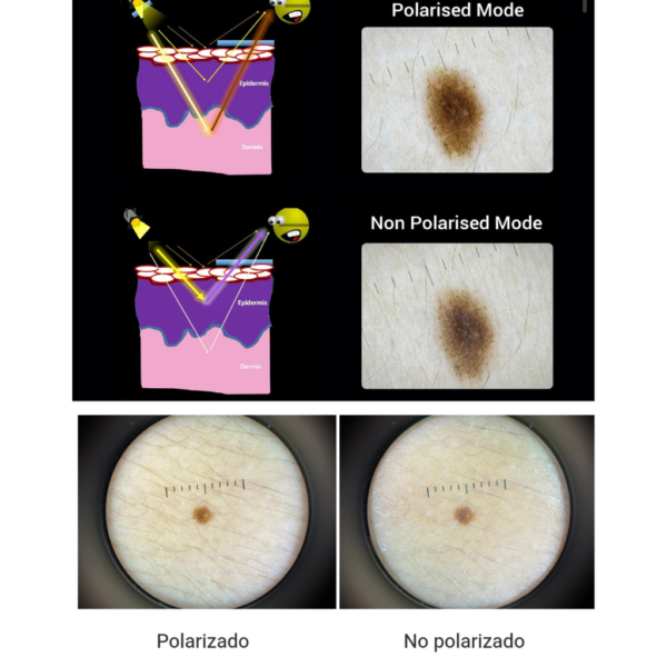 3 Dermatoscopia Profesional Digital Polarizado UV GlowUp DE-500™