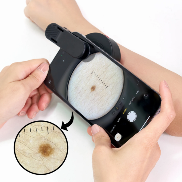 8 Dermatoscopia Profesional Digital Polarizado UV GlowUp DE-500™