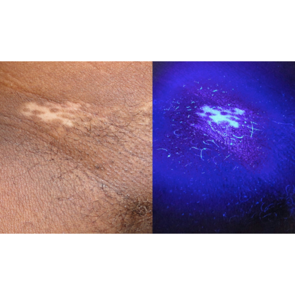 Lámpara Médica de Wood UV Profesional  GlowUp IBOOLO DE-315™