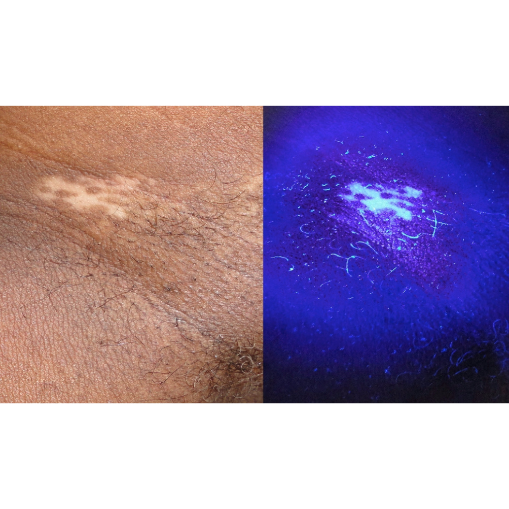 Lámpara Médica de Wood UV Profesional  GlowUp IBOOLO DE-315™